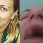 Botucatu: Mulher que caiu de maca no HC e quebrou os dentes recupera o “sorriso” e ganha tratamento para o rosto