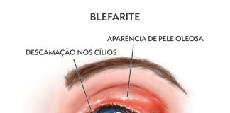 Aumento de Olho Seco por infestação de ácaros Aumento de Olho Seco por infestação de ácaros