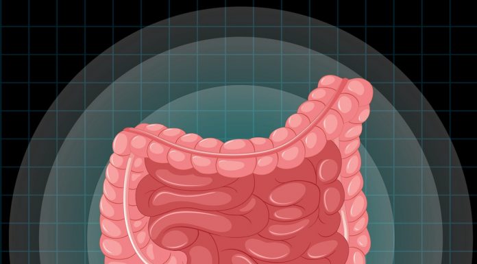 Câncer de intestino: a detecção precoce é fundamental para o tratamento e a cura
