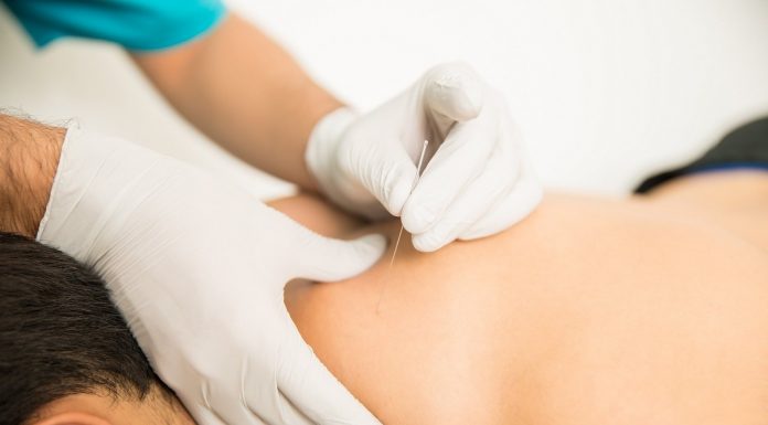 Benefícios da acupuntura na Odontologia