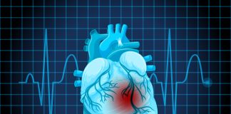 Cardiologista orienta sobre cuidados após o infarto Cardiologista orienta sobre cuidados após o infarto