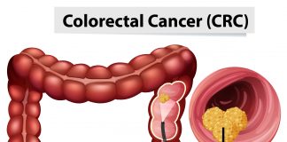 Cresce o diagnóstico de câncer no intestino no Brasil