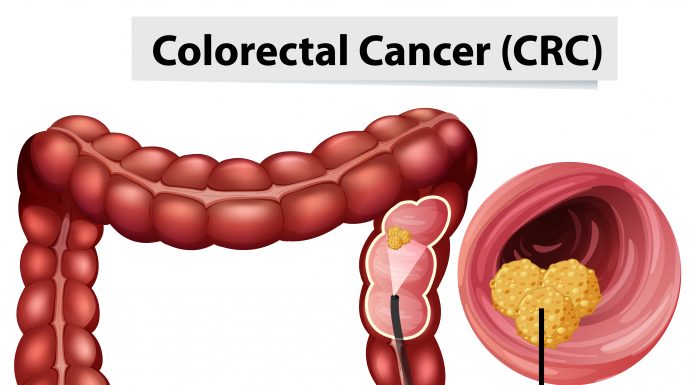 Cresce o diagnóstico de câncer no intestino no Brasil