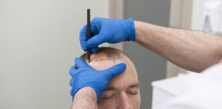 Transplantes capilares modernos ganham popularidade Transplantes capilares modernos ganham popularidade