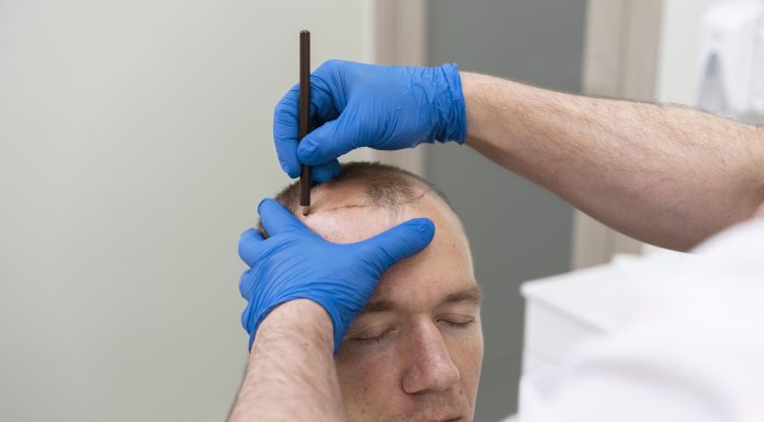 Transplantes capilares modernos ganham popularidade