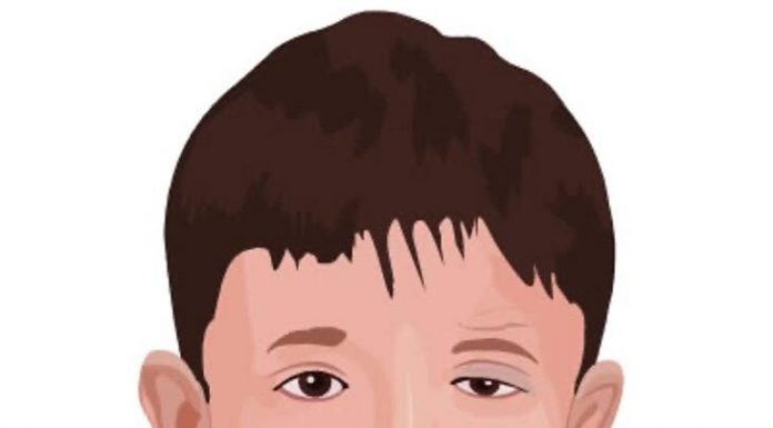 O que é paralisia facial congênita e qual o tratamento?