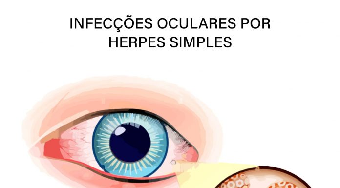 Infecções oculares por Herpes Simples têm tratamento Infecções oculares por Herpes Simples têm tratamento