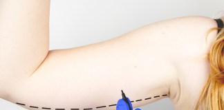 Lipoaspiração é a cirurgia plástica mais comum no Brasil, segundo pesquisa Lipoaspiração é a cirurgia plástica mais comum no Brasil, segundo pesquisa