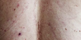 Cicatrizes pós-cirurgia plástica têm tratamento