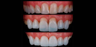 Lente de contato dental podem impulsionar a autoestima