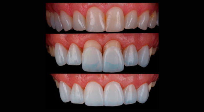 Lente de contato dental podem impulsionar a autoestima