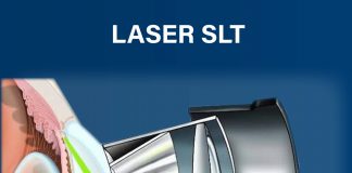 Laser SLT é utilizado no tratamento do glaucoma