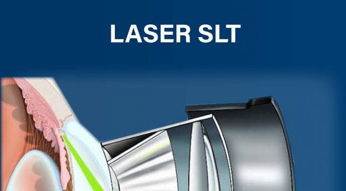 Laser SLT é utilizado no tratamento do glaucoma