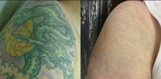 Brasil é segundo país em pesquisa sobre remoção de tatuagem