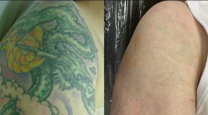 Brasil é segundo país em pesquisa sobre remoção de tatuagem