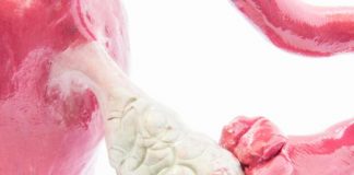 SOP pode atingir até 19% das mulheres em idade reprodutiva