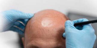 Transplante capilar passa a oferecer melhores resultados Transplante capilar passa a oferecer melhores resultados