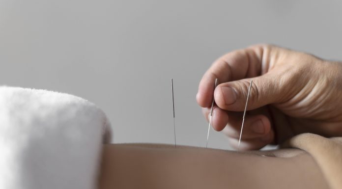 Acupuntura: SUS atende 1 milhão de pessoas anualmente Acupuntura: SUS atende 1 milhão de pessoas anualmente