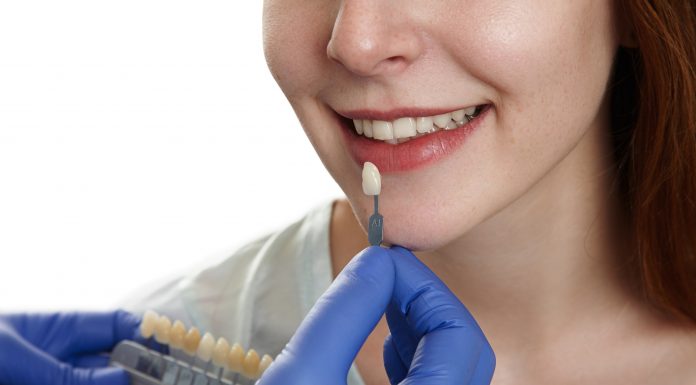 Facetas dentárias precisam de boa higiene bucal