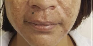 Melasma pode ser tratado com ativos específicos Melasma pode ser tratado com ativos específicos