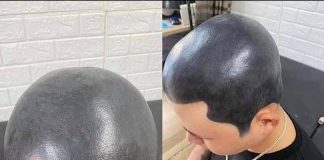 Remoção de micropigmentação pode ser realizada com laser Remoção de micropigmentação pode ser realizada com laser