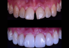 Lentes de contato dental podem ser aplicadas em restaurações