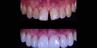 Lentes de contato dental podem ser aplicadas em restaurações