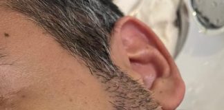 Transplante de barba cresce no mercado masculino