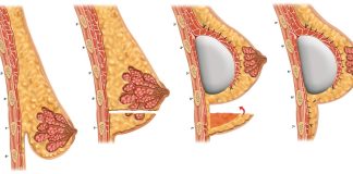 Técnica brasileira de mastopexia é sistematizada