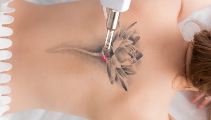 Remoção de tatuagens cresce e evolui suas técnicas Remoção de tatuagens cresce e evolui suas técnicas