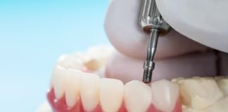 Implante zigomático garante tratamento ágil a pacientes