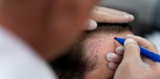 Técnica FUE: especialista explica o que é e como funciona