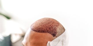 Transplante capilar lidera buscas no Google