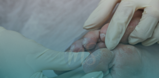 Estomaterapeuta trata ferida crônica e promove autocuidado eficaz