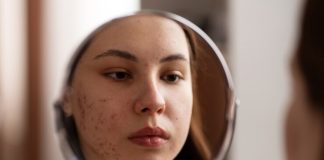 Acne se torna cada vez mais comum entre mulheres adultas Acne se torna cada vez mais comum entre mulheres adultas