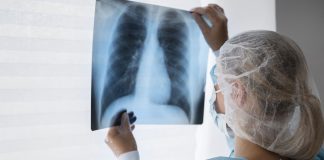 Câncer de pulmão chega em fase avançada para 91% dos casos