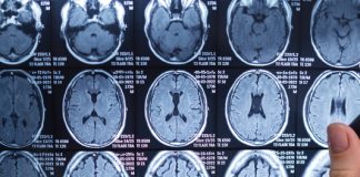 Neurocirurgião esclarece dúvidas sobre tumor cerebral