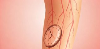 Diagnóstico precoce melhora tratamentos para varizes