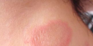 Hanseníase no Brasil é epidemia silenciosa