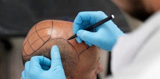 Transplante capilar: mercado crescerá 21% até 2032 Transplante capilar: mercado crescerá 21% até 2032