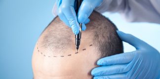Técnica FUE otimiza resultados do transplante capilar