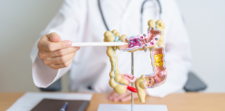 Com diagnóstico precoce, câncer colorretal tem 90% de cura