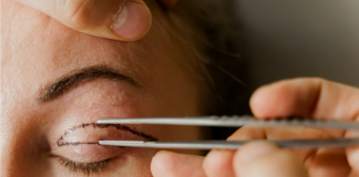 Blefaroplastia: procedimento que rejuvenesce o olhar