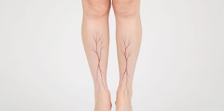 Obesidade e sobrepeso afetam a saúde vascular de brasileiros Obesidade e sobrepeso afetam a saúde vascular de brasileiros