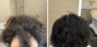 Inovações ajudam a popularizar busca por transplante capilar Inovações ajudam a popularizar busca por transplante capilar