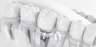 Implante zigomático traz nova alternativa na implantodontia