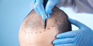 Busca por transplante capilar cresce no Brasil Busca por transplante capilar cresce no Brasil