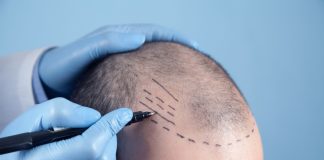 Pacientes buscam naturalidade no transplante capilar