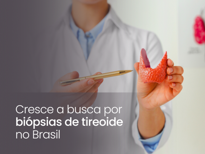 Cresce a busca por biópsias de tireoide no Brasil Cresce a busca por biópsias de tireoide no Brasil