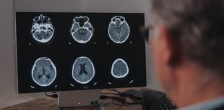 Maio Cinza: mês reforça a conscientização sobre o câncer cerebral